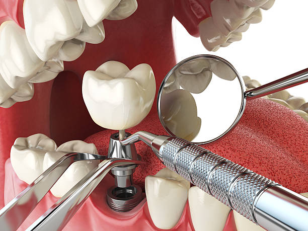 Best Emergency Dental Extractions in Glen Rock, PA